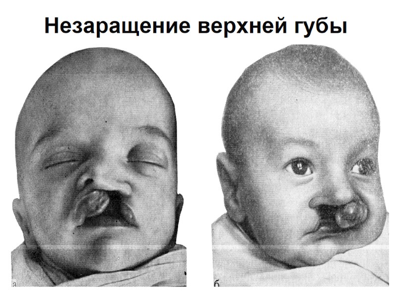 Незаращение верхней губы